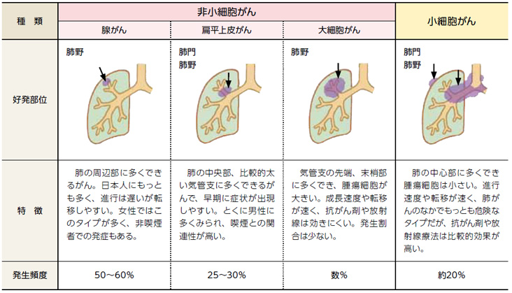 肺がんの種類